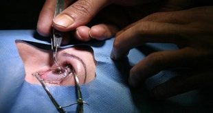 دون تداخل جراحي.. فريق طبي ينقذ شابة من “العمى” نتيجة العدسات اللاصقة ببغداد