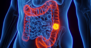 دراسة تحدد شكل الجسم الذي يزيد خطر الإصابة بسرطان القولون