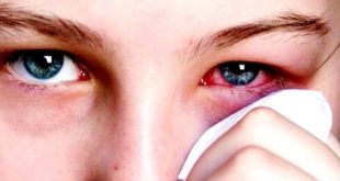 قد تؤدي إلى العمى.. ما هي جلطة العين وكيف تحدث؟