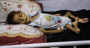 “أونروا”: 508 أطفال في غزة مصابون بسوء تغذية حاد